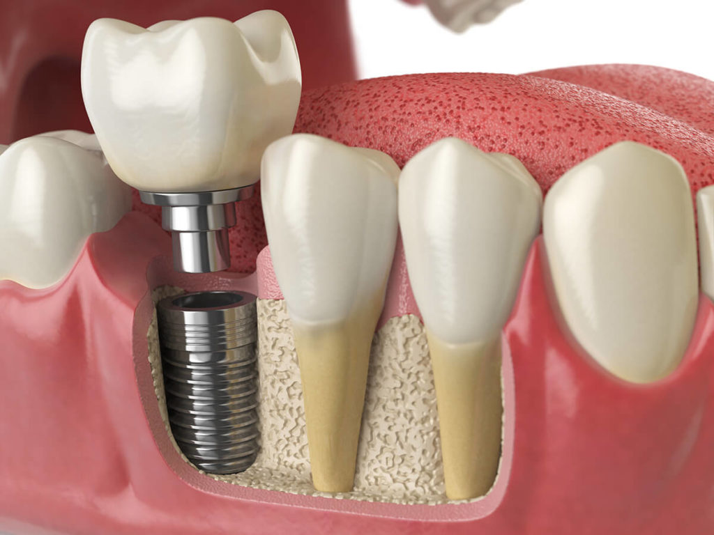 Implantes Dentários - Ozawa & Kakizawa Odontologia