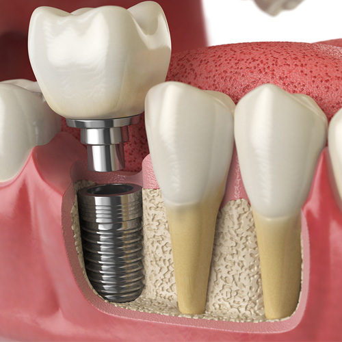 Implantes Dentários - Ozawa & Kakizawa Odontologia